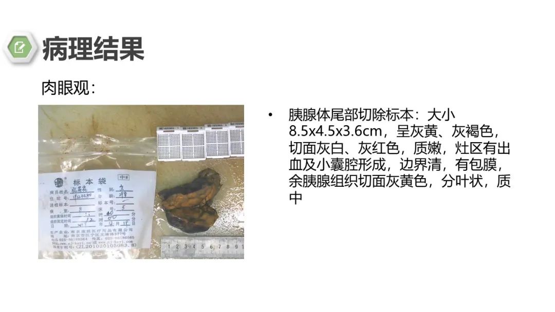 影像PPT - 【病例】胰腺实性假乳头状瘤1例CT影像-12