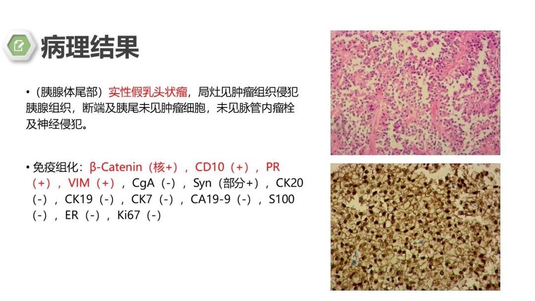 影像PPT - 【病例】胰腺实性假乳头状瘤1例CT影像-13