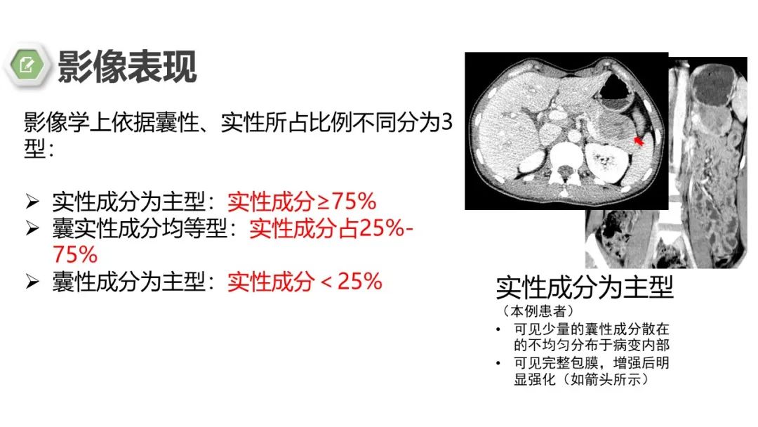 影像PPT - 【病例】胰腺实性假乳头状瘤1例CT影像-19