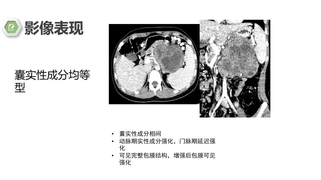 影像PPT - 【病例】胰腺实性假乳头状瘤1例CT影像-20