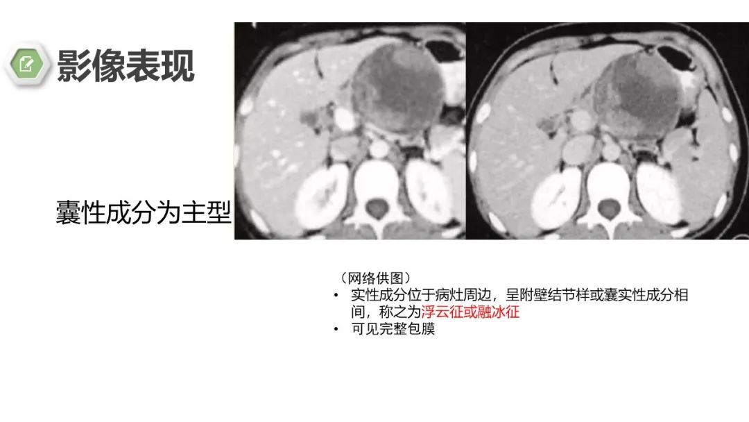 影像PPT - 【病例】胰腺实性假乳头状瘤1例CT影像-21
