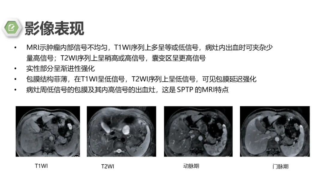 影像PPT - 【病例】胰腺实性假乳头状瘤1例CT影像-23
