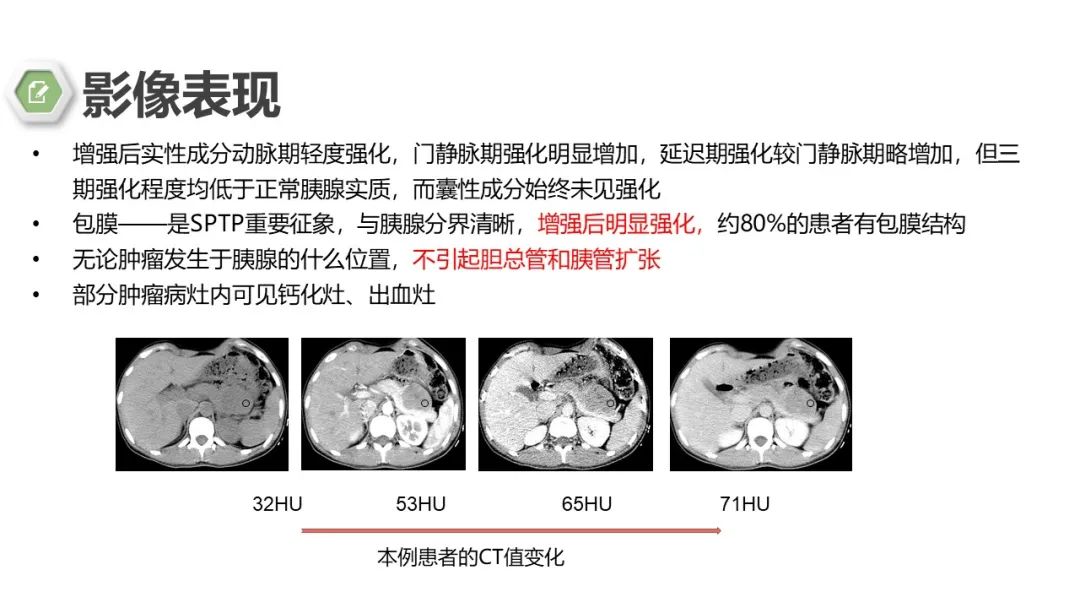 影像PPT - 【病例】胰腺实性假乳头状瘤1例CT影像-22