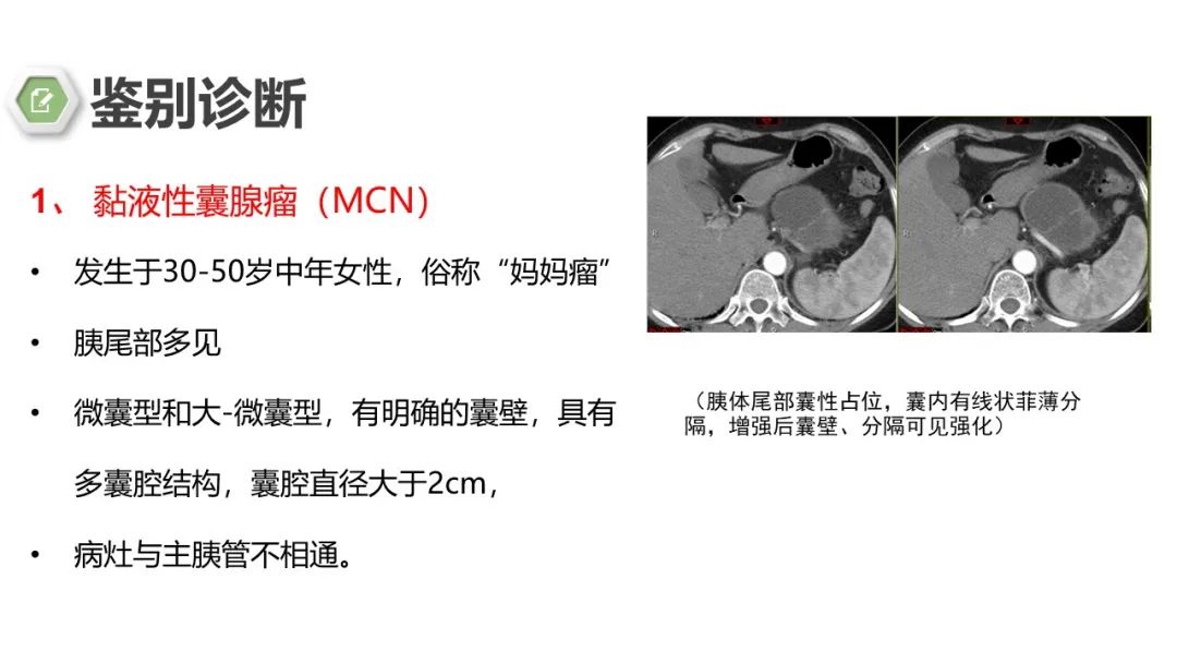 影像PPT - 【病例】胰腺实性假乳头状瘤1例CT影像-25