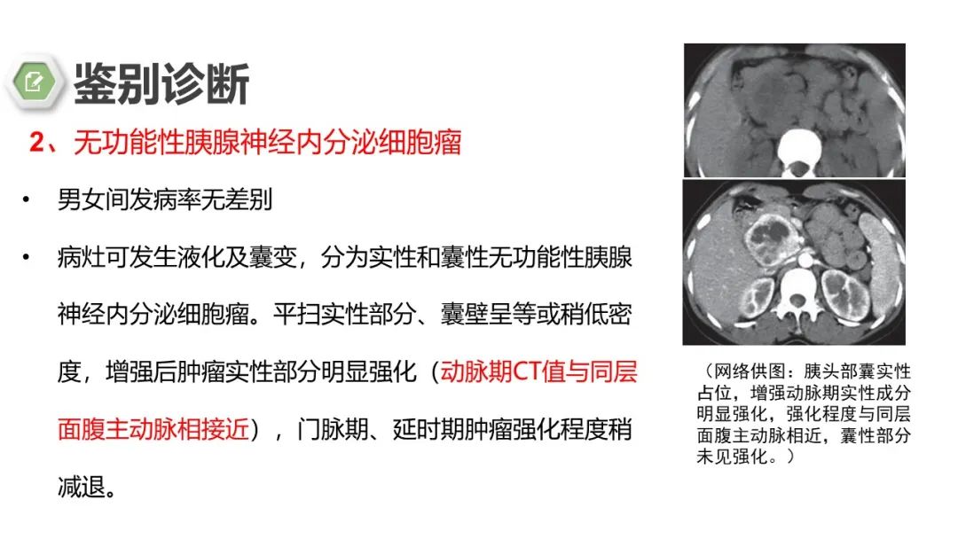 影像PPT - 【病例】胰腺实性假乳头状瘤1例CT影像-26