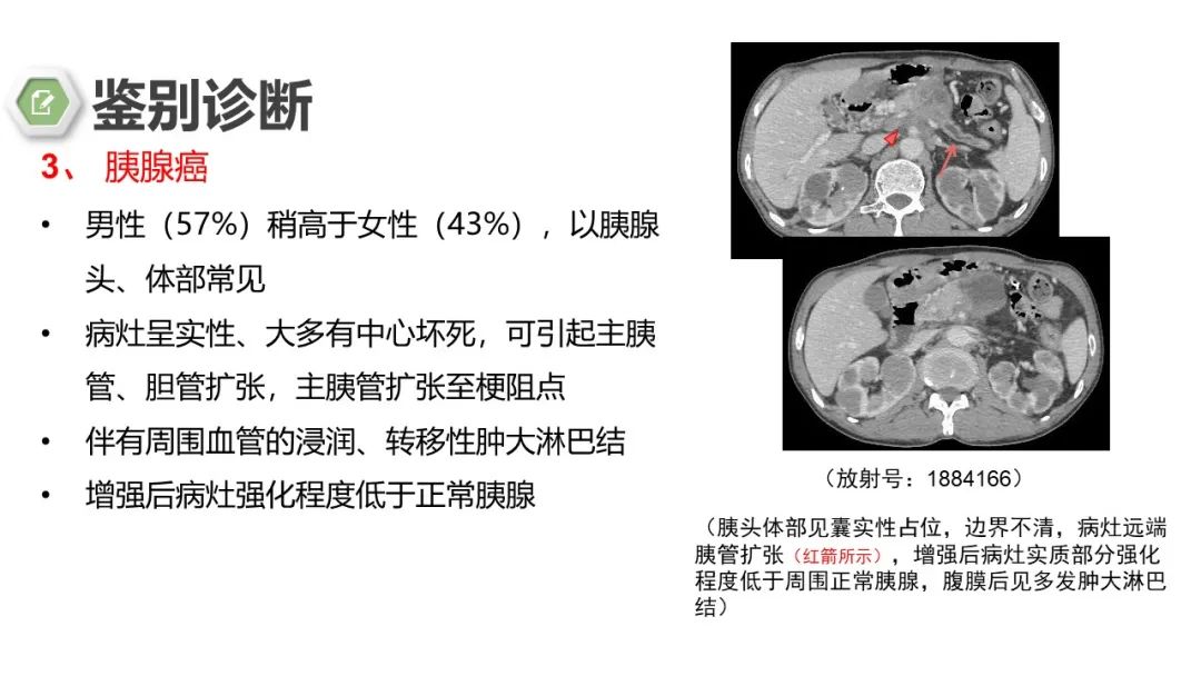 影像PPT - 【病例】胰腺实性假乳头状瘤1例CT影像-27