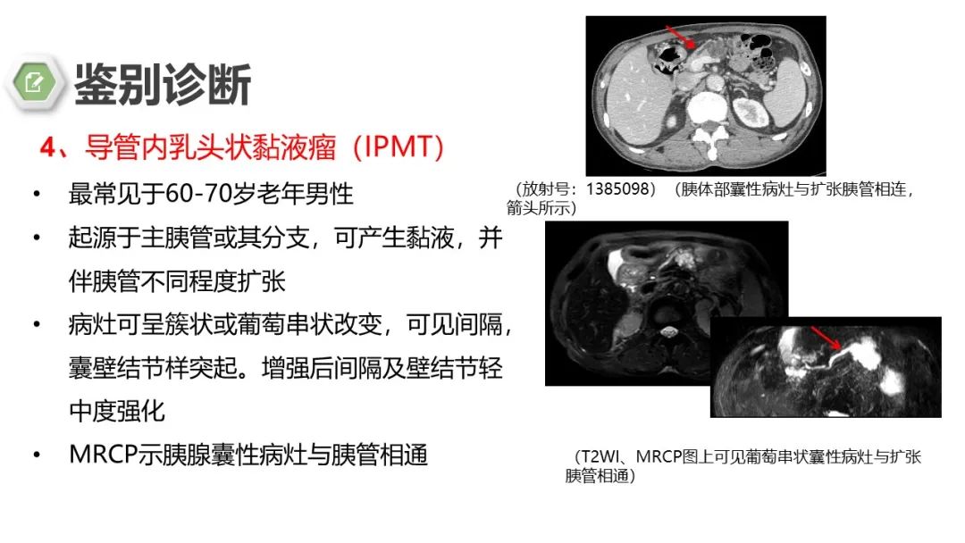 影像PPT - 【病例】胰腺实性假乳头状瘤1例CT影像-28