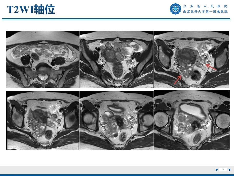 影像PPT - 【PPT】静脉内的“爬山虎”——静脉内平滑肌瘤病-3