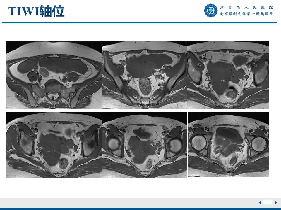 影像PPT - 【PPT】静脉内的“爬山虎”——静脉内平滑肌瘤病-4