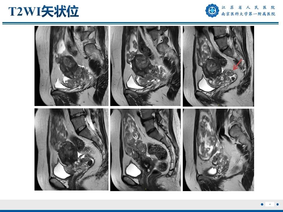 影像PPT - 【PPT】静脉内的“爬山虎”——静脉内平滑肌瘤病-5