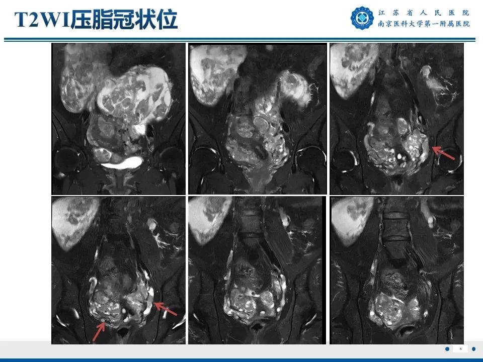 影像PPT - 【PPT】静脉内的“爬山虎”——静脉内平滑肌瘤病-6