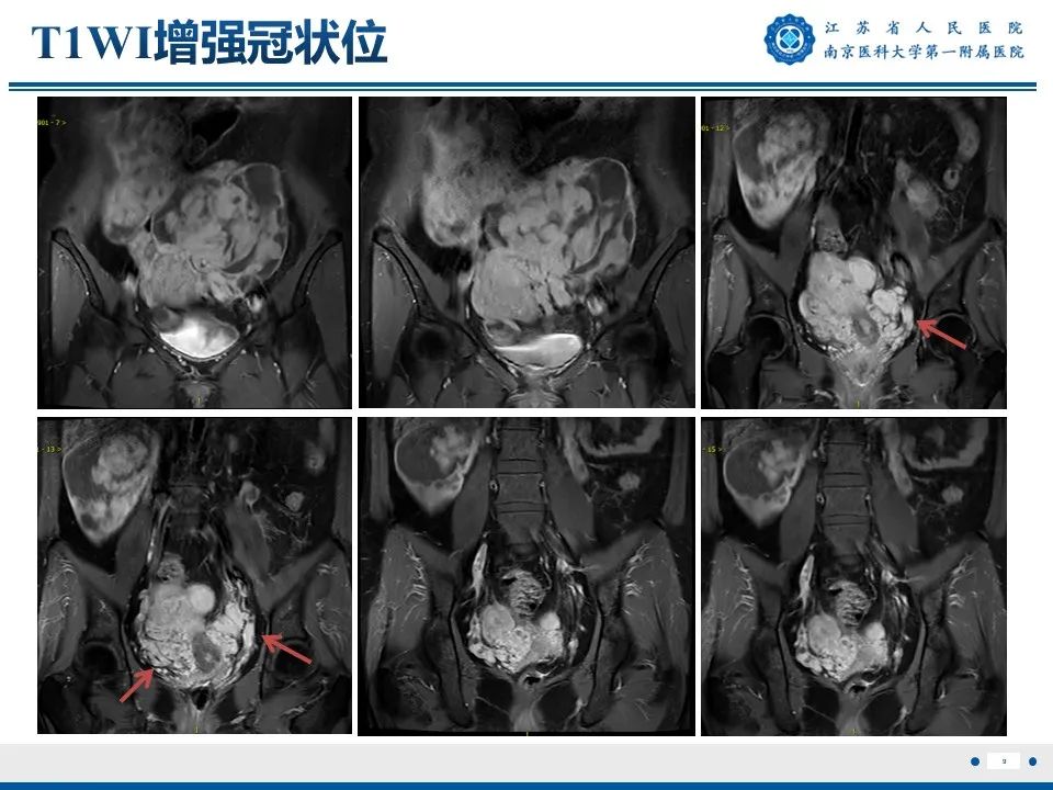 影像PPT - 【PPT】静脉内的“爬山虎”——静脉内平滑肌瘤病-10