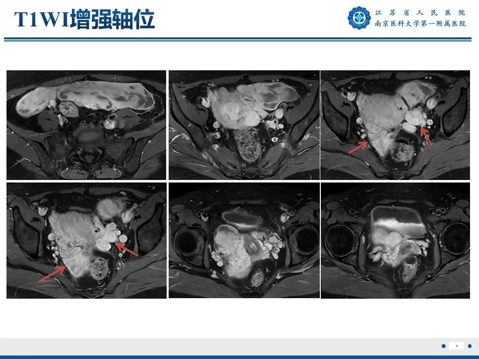 影像PPT - 【PPT】静脉内的“爬山虎”——静脉内平滑肌瘤病-9