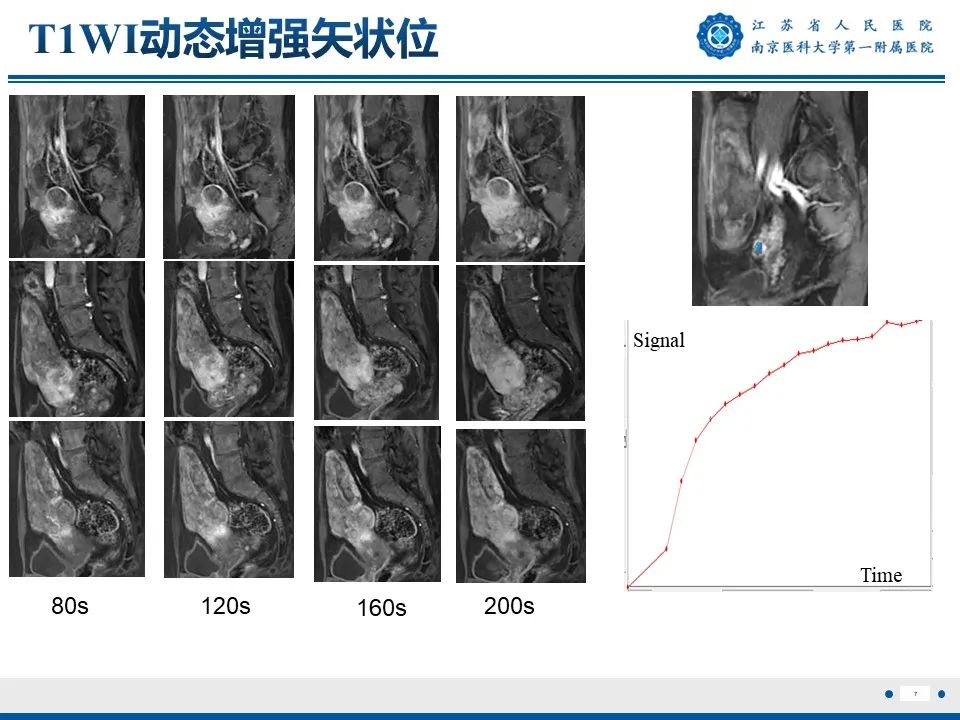 影像PPT - 【PPT】静脉内的“爬山虎”——静脉内平滑肌瘤病-8