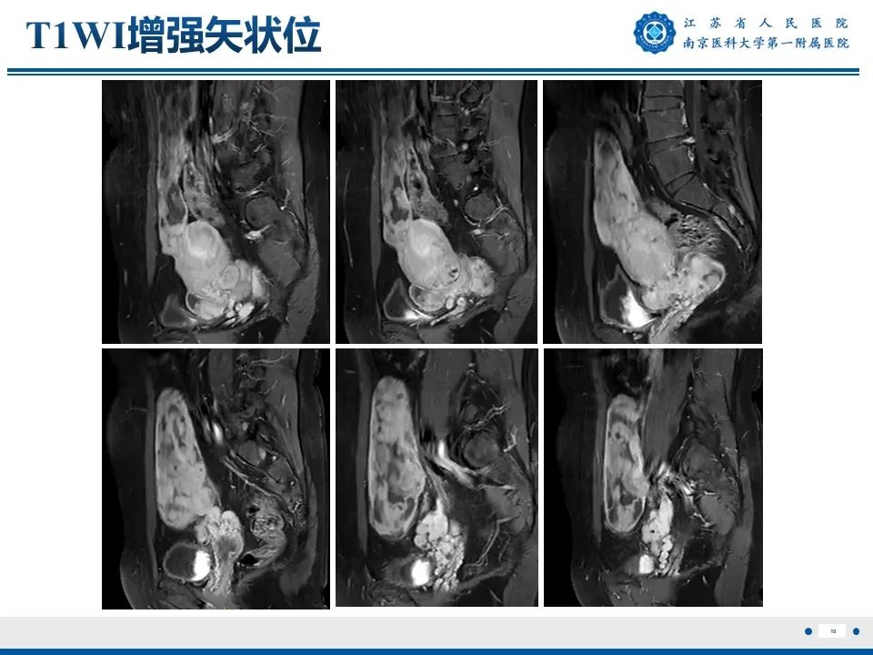 影像PPT - 【PPT】静脉内的“爬山虎”——静脉内平滑肌瘤病-11