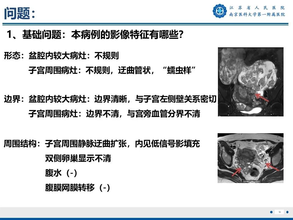 影像PPT - 【PPT】静脉内的“爬山虎”——静脉内平滑肌瘤病-13