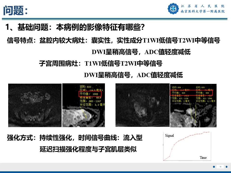 影像PPT - 【PPT】静脉内的“爬山虎”——静脉内平滑肌瘤病-14