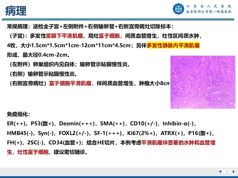 影像PPT - 【PPT】静脉内的“爬山虎”——静脉内平滑肌瘤病-23
