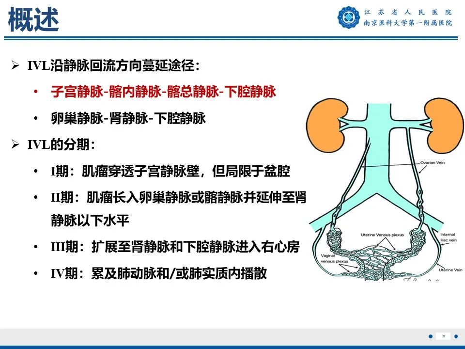 影像PPT - 【PPT】静脉内的“爬山虎”——静脉内平滑肌瘤病-28