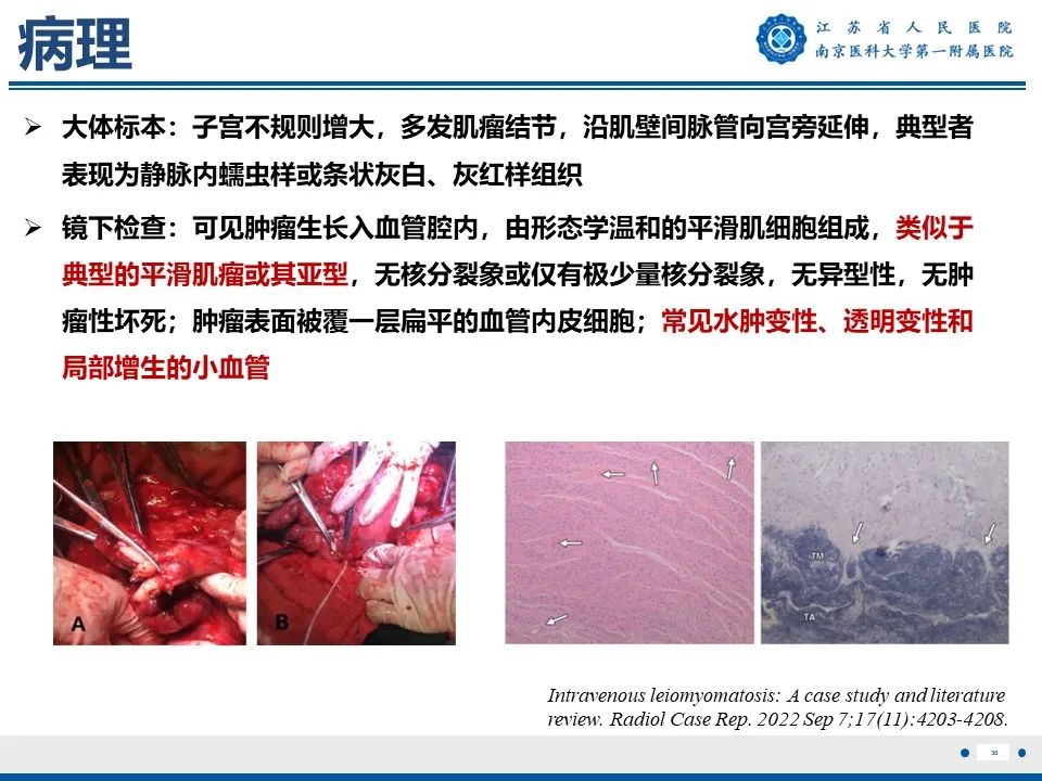 影像PPT - 【PPT】静脉内的“爬山虎”——静脉内平滑肌瘤病-31