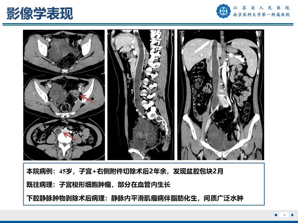 影像PPT - 【PPT】静脉内的“爬山虎”——静脉内平滑肌瘤病-33