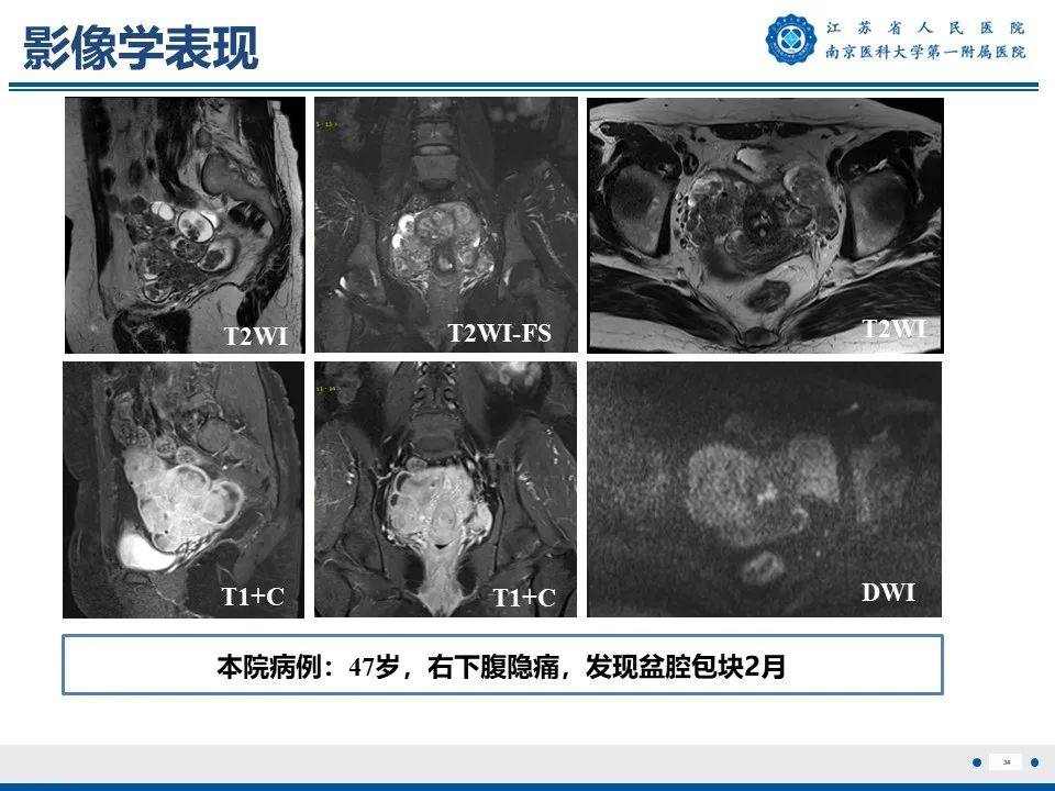 影像PPT - 【PPT】静脉内的“爬山虎”——静脉内平滑肌瘤病-35