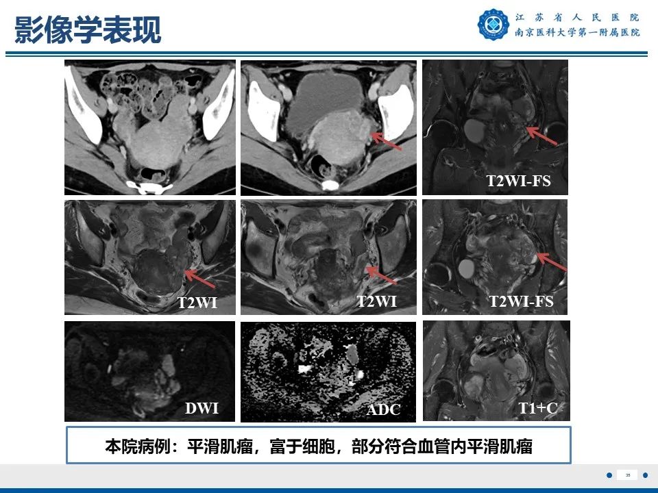 影像PPT - 【PPT】静脉内的“爬山虎”——静脉内平滑肌瘤病-36