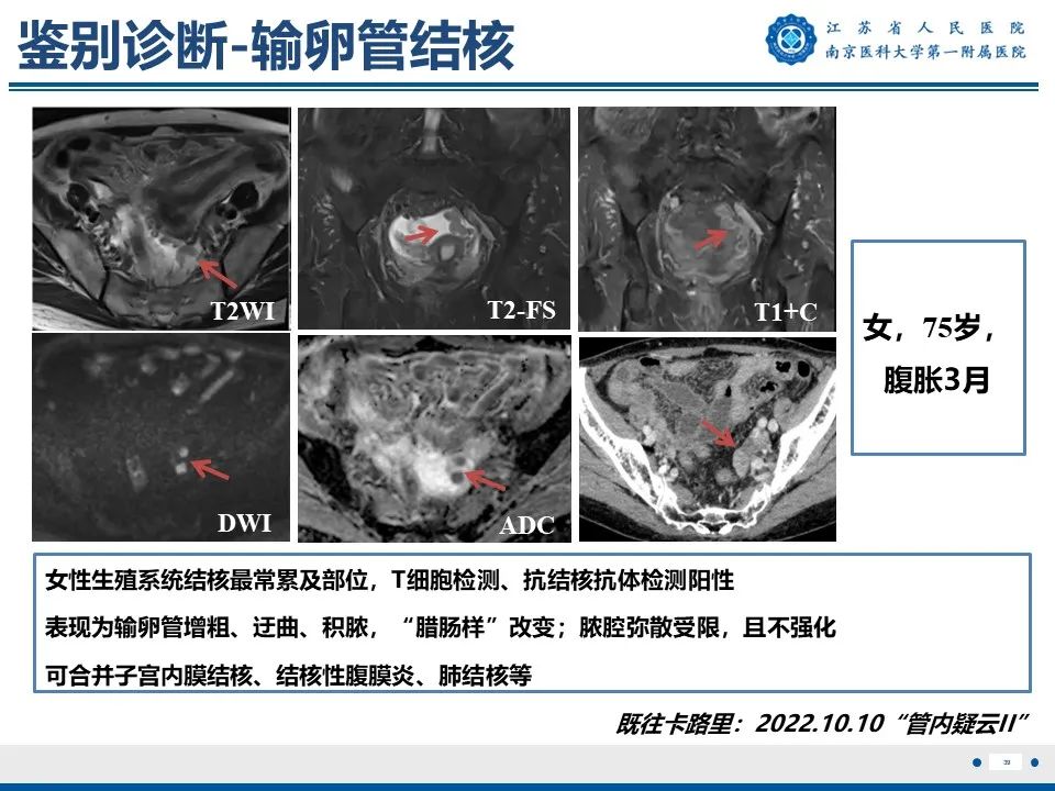 影像PPT - 【PPT】静脉内的“爬山虎”——静脉内平滑肌瘤病-40