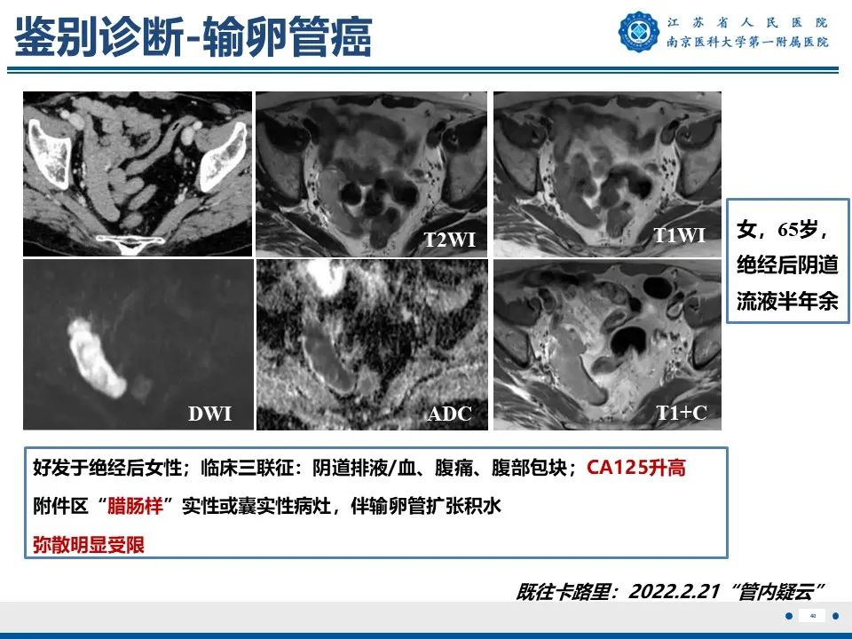 影像PPT - 【PPT】静脉内的“爬山虎”——静脉内平滑肌瘤病-41
