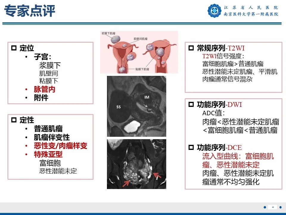 影像PPT - 【PPT】静脉内的“爬山虎”——静脉内平滑肌瘤病-46