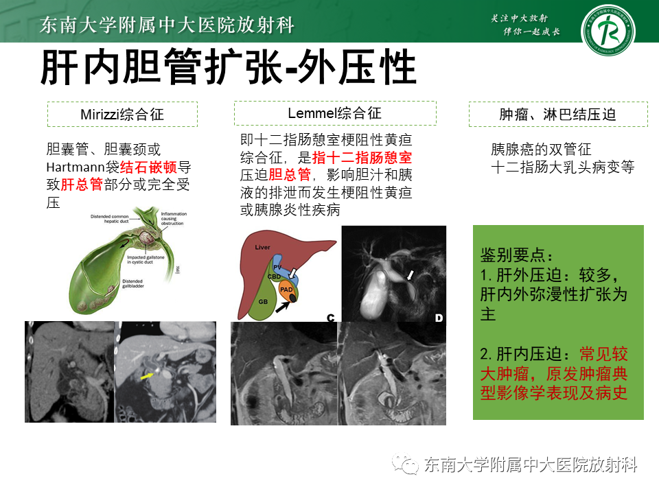 影像PPT - 【PPT】继发性肝内胆管局部扩张影像诊断-8