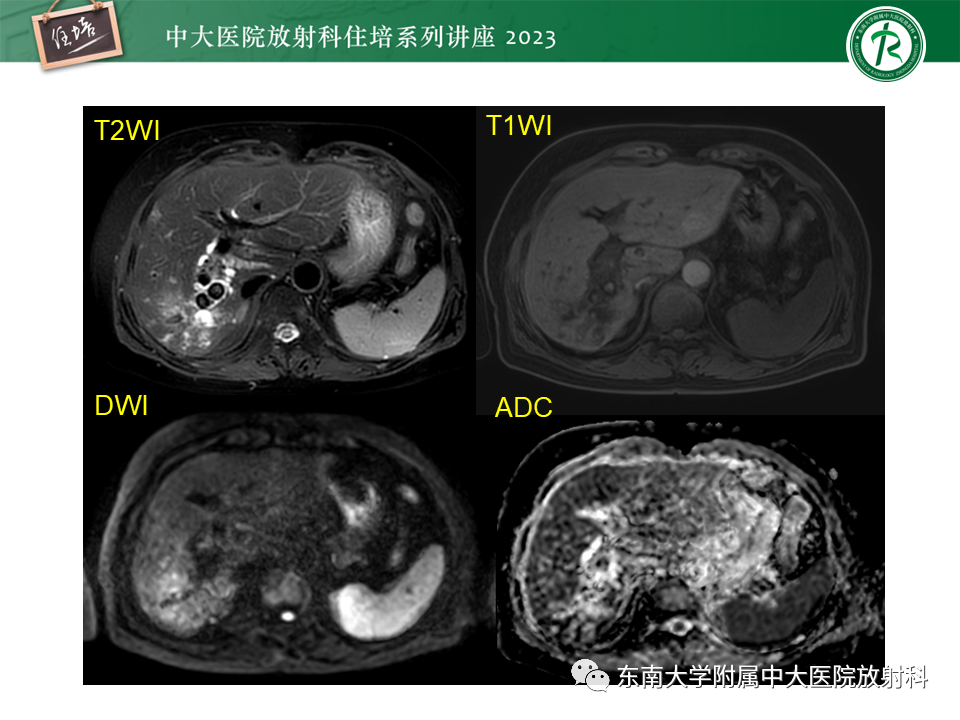 影像PPT - 【PPT】继发性肝内胆管局部扩张影像诊断-14