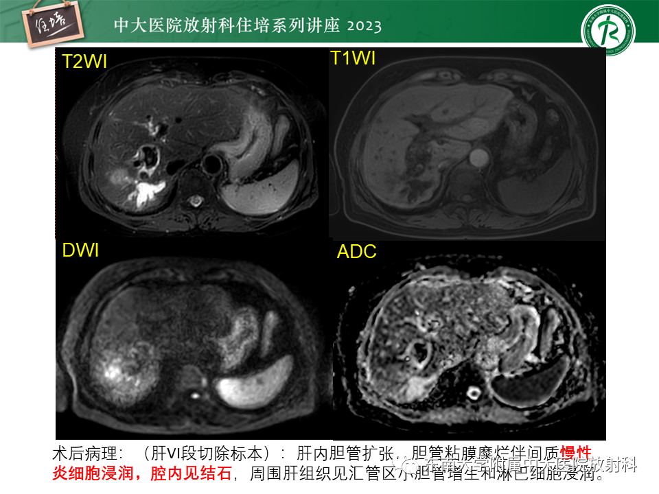 影像PPT - 【PPT】继发性肝内胆管局部扩张影像诊断-15