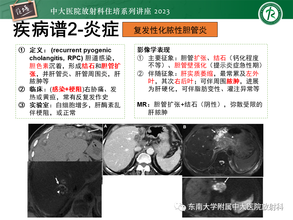 影像PPT - 【PPT】继发性肝内胆管局部扩张影像诊断-17
