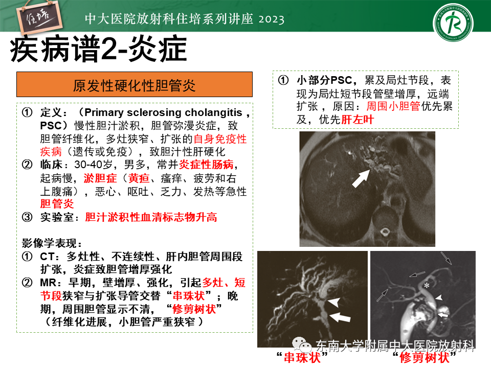 影像PPT - 【PPT】继发性肝内胆管局部扩张影像诊断-18