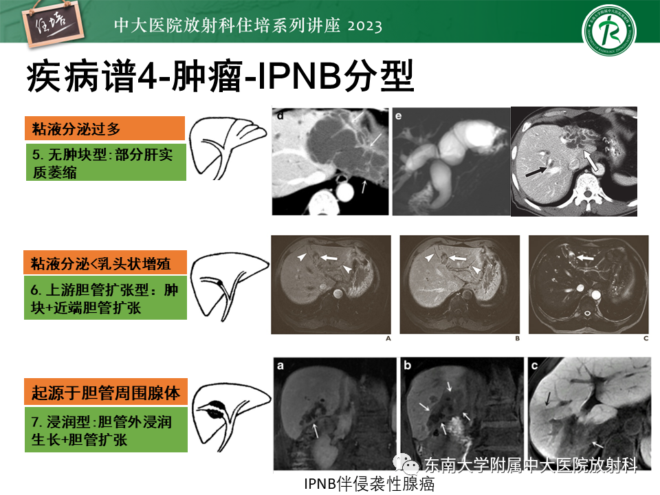 影像PPT - 【PPT】继发性肝内胆管局部扩张影像诊断-22