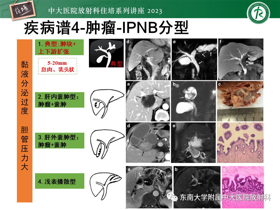 影像PPT - 【PPT】继发性肝内胆管局部扩张影像诊断-21