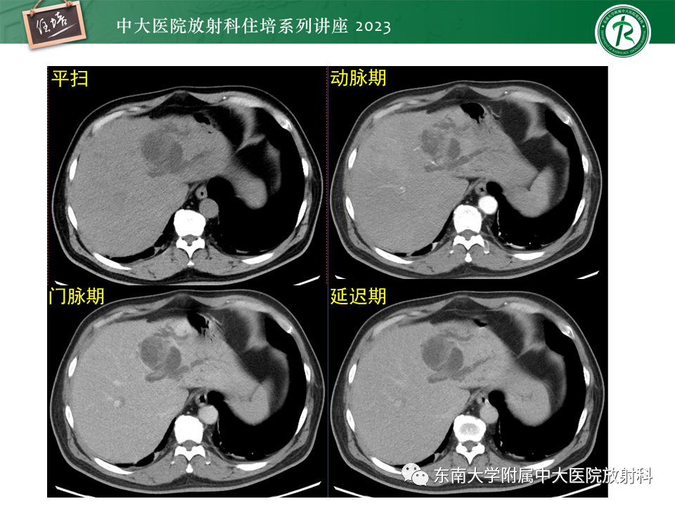 影像PPT - 【PPT】继发性肝内胆管局部扩张影像诊断-25