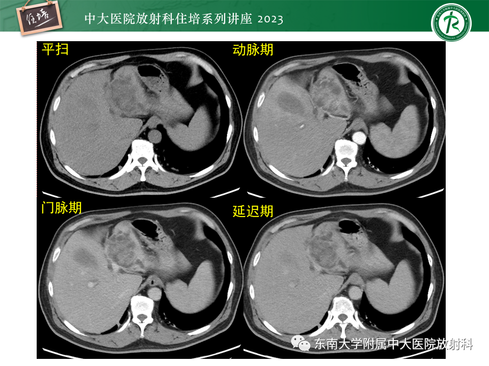 影像PPT - 【PPT】继发性肝内胆管局部扩张影像诊断-27