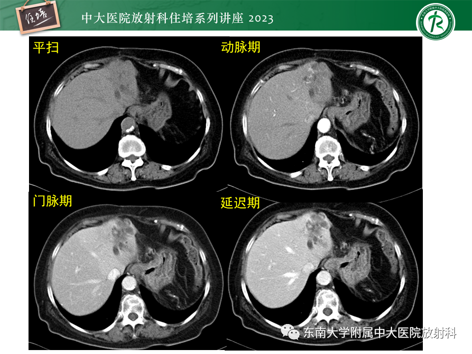 影像PPT - 【PPT】继发性肝内胆管局部扩张影像诊断-32