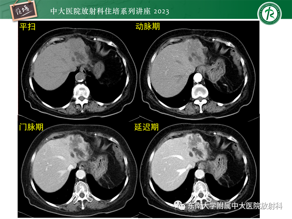 影像PPT - 【PPT】继发性肝内胆管局部扩张影像诊断-33