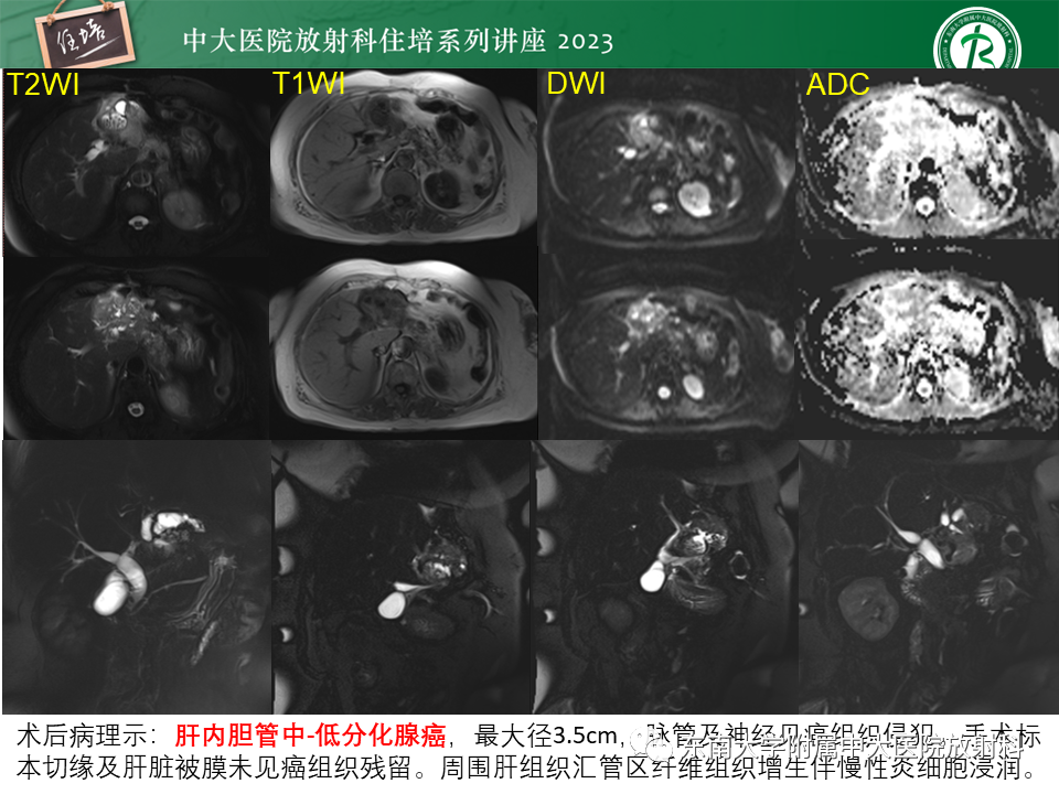 影像PPT - 【PPT】继发性肝内胆管局部扩张影像诊断-34