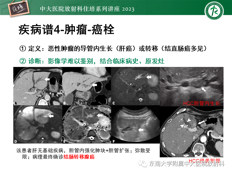 影像PPT - 【PPT】继发性肝内胆管局部扩张影像诊断-37