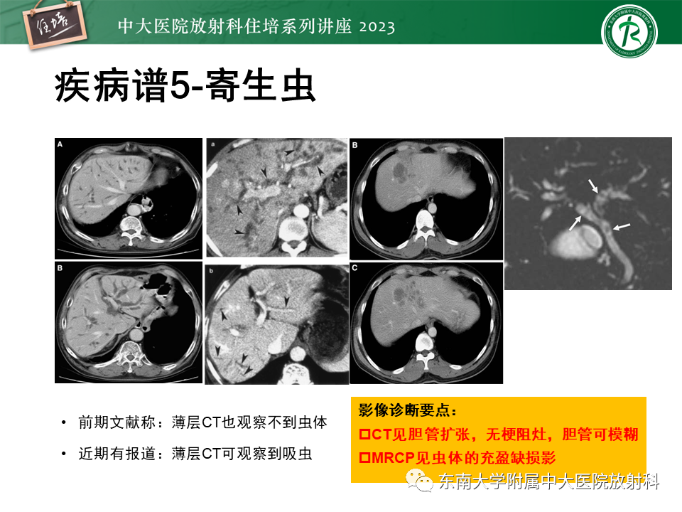 影像PPT - 【PPT】继发性肝内胆管局部扩张影像诊断-39
