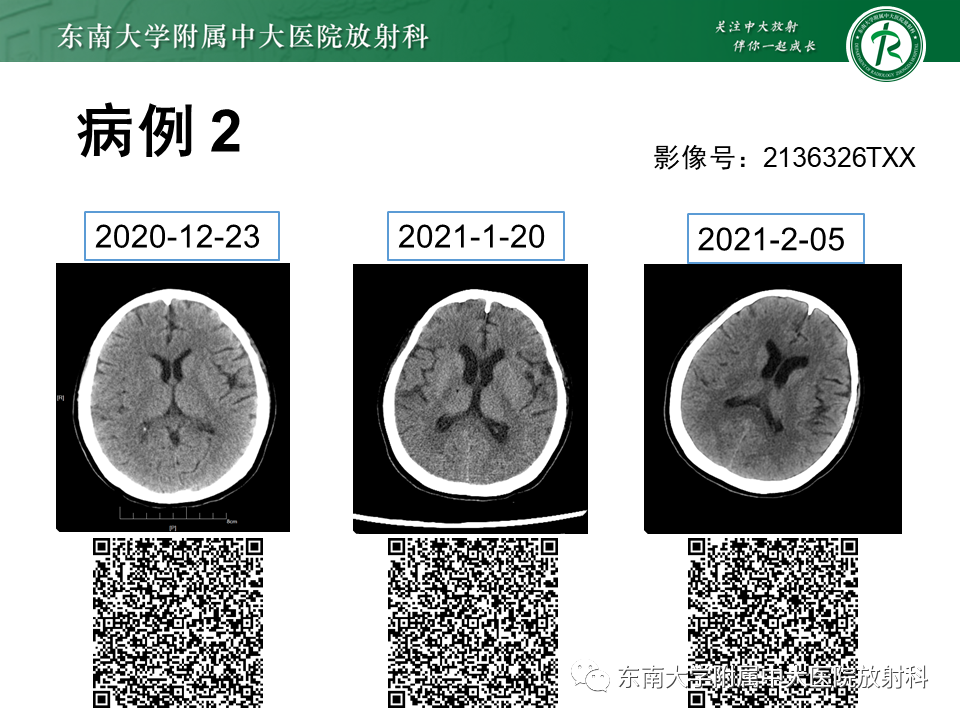 影像PPT - 【PPT】成人脑白质受累为主的弥漫/融合分布病变的诊断思路-8