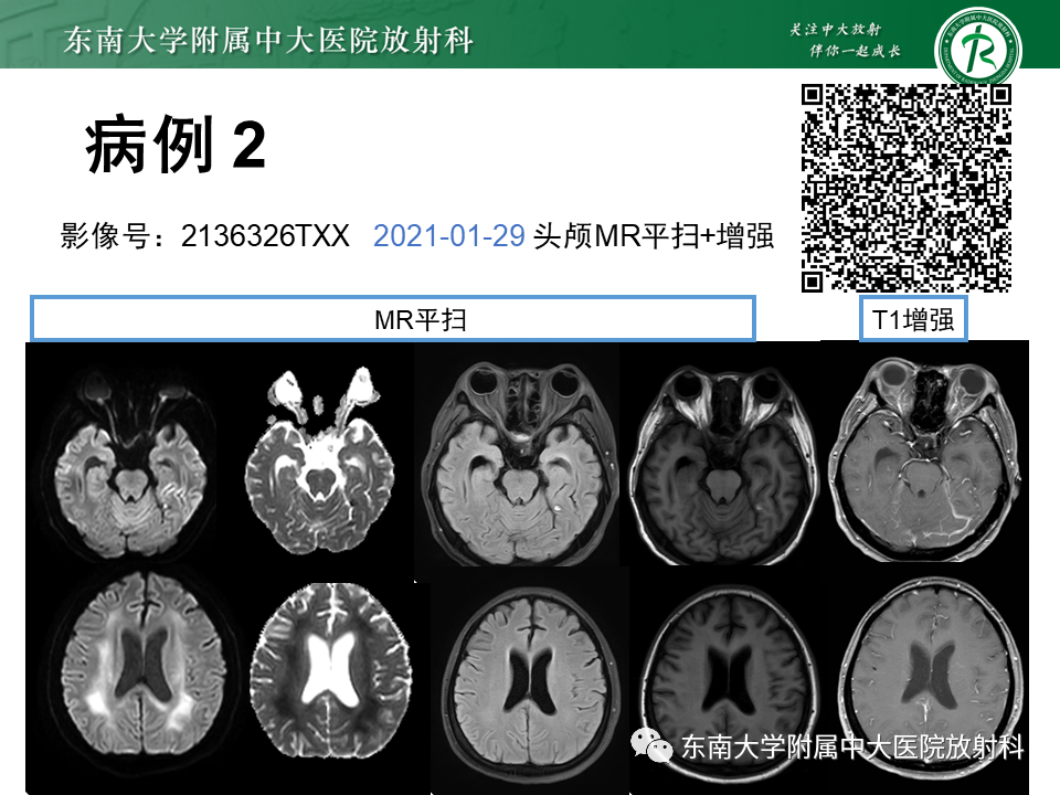 影像PPT - 【PPT】成人脑白质受累为主的弥漫/融合分布病变的诊断思路-7