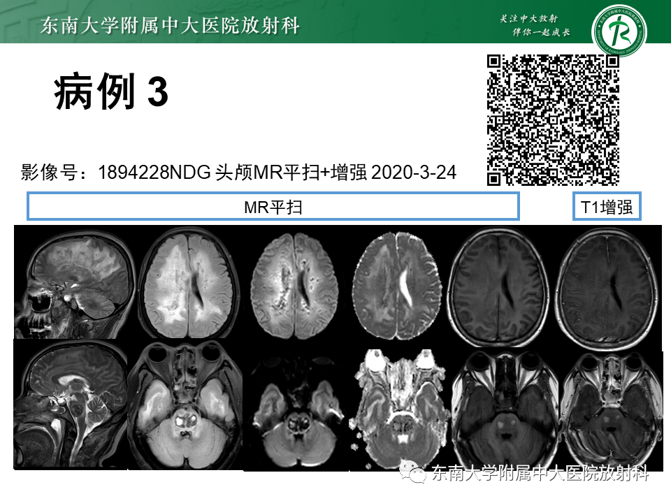 影像PPT - 【PPT】成人脑白质受累为主的弥漫/融合分布病变的诊断思路-12