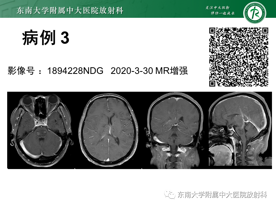 影像PPT - 【PPT】成人脑白质受累为主的弥漫/融合分布病变的诊断思路-13