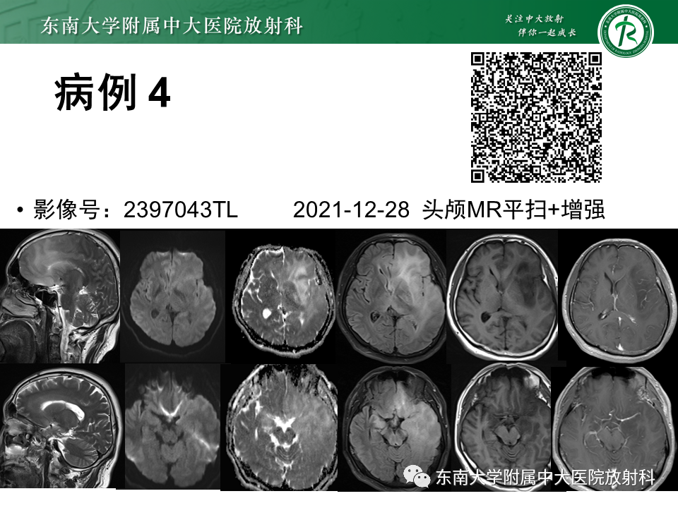 影像PPT - 【PPT】成人脑白质受累为主的弥漫/融合分布病变的诊断思路-15