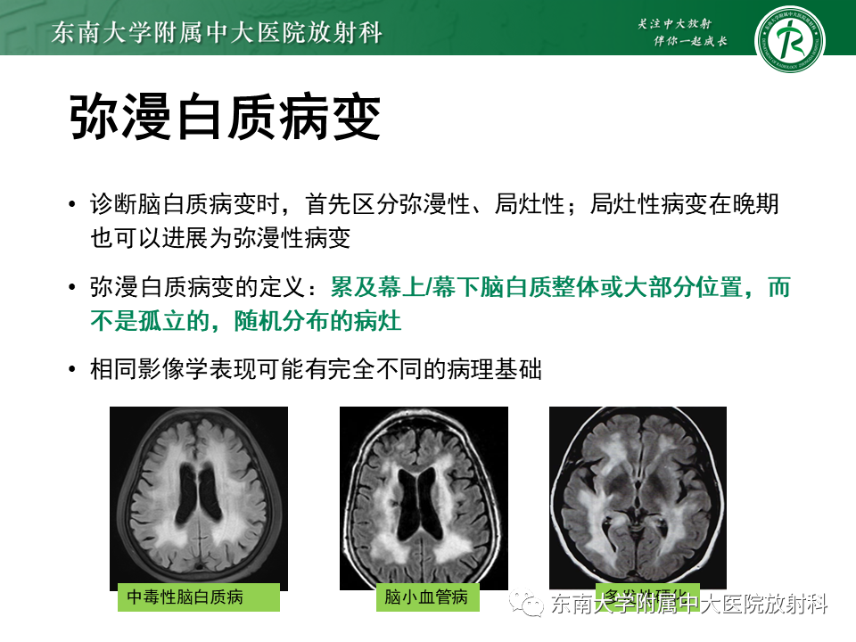 影像PPT - 【PPT】成人脑白质受累为主的弥漫/融合分布病变的诊断思路-28